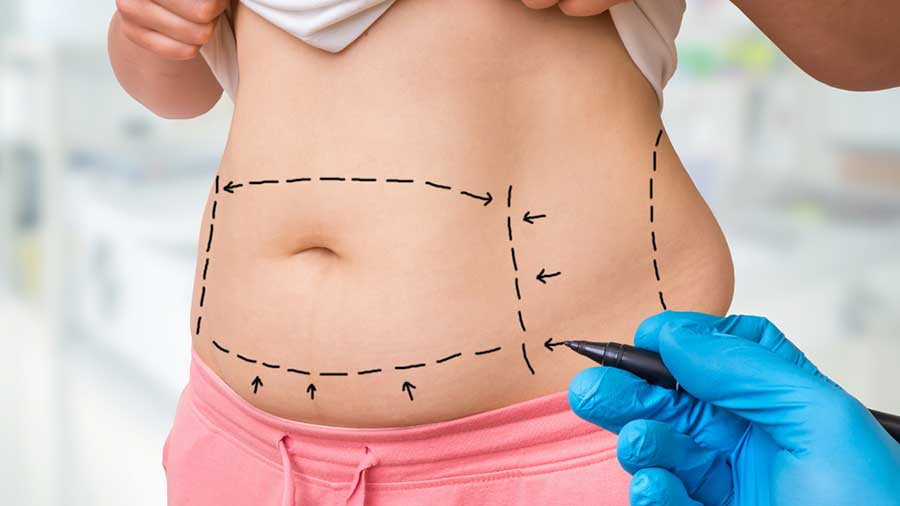 What Is Involved With A Tummy Tuck Procedure?